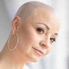 503f9fdd-alopecia_1064064000000000000000