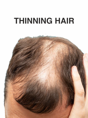 Thinning-hair-scalp-micropigmentation