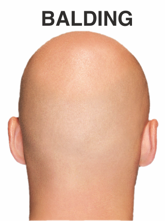 Balding