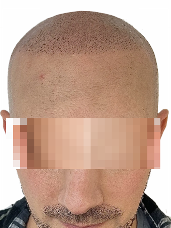 scalp-micropigmentation-after-2