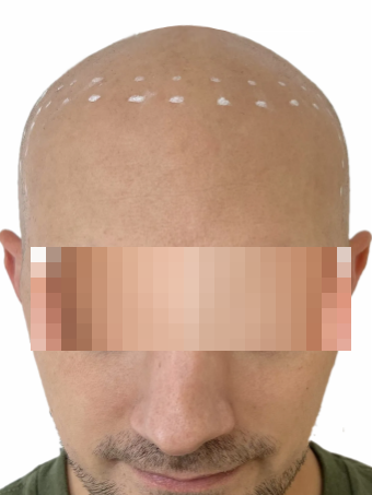 scalp-micropigmentation-before-4